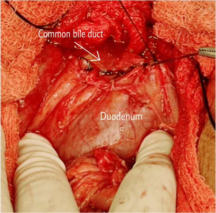 Anastomosis between the duodenum and common bile duct
