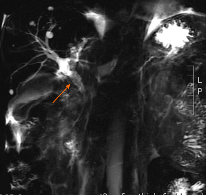 Magnetic resonance cholangiopancreatography. Findings of dilatation of the common bile duct, stenosis of the distal common bile duct, and density shadow of soft tissue are indicated by an arrow.
