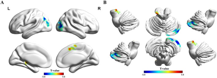 Differences in ReHo between patients with ASD and TDCs. Brain regions showing significant differences were the bilateral middle occipital gyrus, right cerebellum crus I and II, supplementary motor area, and left angular gyrus, thalamus, parahippocampal gyrus, and hippocampus. The colorbars represent the t‐values: Warmer hues (positive values) indicate higher ReHo values in patients with ASD than in TDCs (patients>controls), while cooler hues (negative values) indicate the opposite (patients<controls).