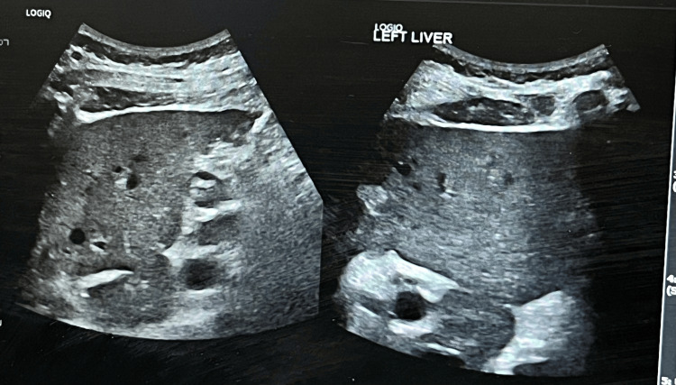 Ultrasound image showing no signs of cirrhosis or bile duct obstruction.