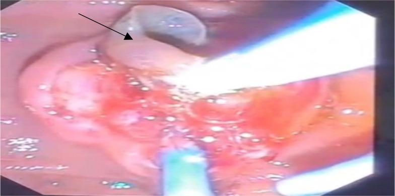 Alive Fasciola sp. excised from the gallbladder during the endoscopic retrograde cholangiopancreatography (ERCP) procedure