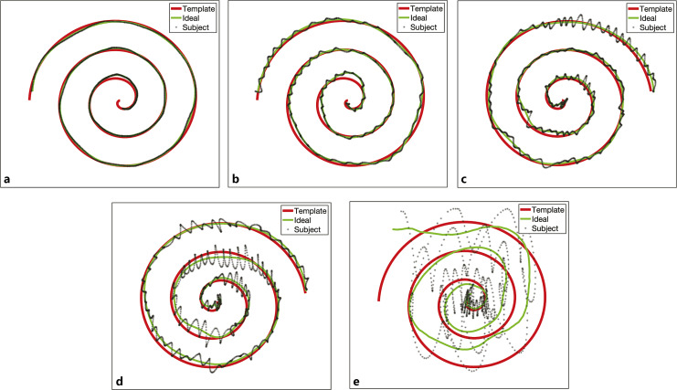 Sample spirograms from a normal subject (a) and ET subjects with mild to increasingly severe tremors (b–e). The template (red line), ideal spiral (green line), and subject’s spiral (black line) data are shown using the proposed method. The tremor magnitude or perpendicular displacement [2, 30] thus represents the difference between the subject’s actual spirogram and the ideal spirogram.