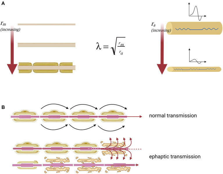 Nerve impulse propagation in axons with normal and reduced diameter. (A) Lambda space constant (λ) is an index of how the difference in membrane potential propagates along with the fiber at distance. Moreover, space constant is directly proportional to the membrane resistance (rm), which opposes the escape of ions that must proceed along the axon to transmit the signal and inversely proportional to axial resistance (ra), which opposes the propagation of the action potential along the axon. The membrane resistance increases enormously with the myelination of the fiber, which isolates the axon from current leakage. The axial resistance instead is a direct measure of axonal diameter, so the greater the diameter of the axon, the easier it will be the propagation of excitation at a distance, the smaller the diameter of the axon, the greater the probability that the fiber will suffer a conduction block. From this model, it is clear that the fibers of small diameter are more sensitive to the effects of demyelination because they have high axial resistance. (B) The nerve fiber function deficit in the case of SPS can be explained as an effect of ephaptic transmission. In this way when an action potential arises, perturbing the extracellular medium, the excitation is transferred to neighboring axons. Specifically, there is a transverse propagation of excitation from one axon to another, independently of the synaptic junction.