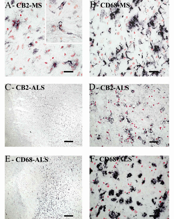 CB2 staining in MS and ALS spinal cord is in microglial cells/macrophages. A) CB2 staining in MS spinal cord. Inset: CB2 staining in parenchymal microglial cells/macrophages. (Scale bar = 50 μm). B) Microglia-like immunostaining with CD68 in the same area as in A (Scale bar = 50 μm). C and D) CB2 staining in ALS spinal cord (Scale bar = 500 μm and 50 μm, respectively). E and F) Microglia-like immunostaining with CD68 (Scale bar = 500 μm and 50 μm, respectively).