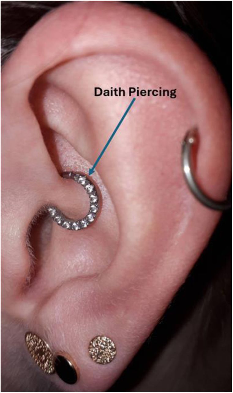 Daith piercing on the crus of the helix.