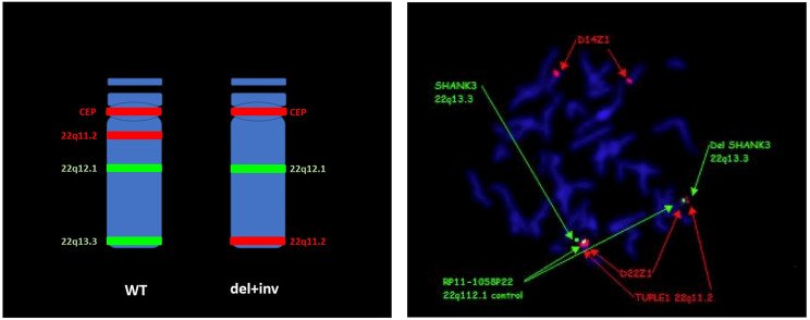 FISH markers on chromosome 22. CEP = D22Z1 (red); 22q11.2 = TUPLE1 D22S451 (red); 22q12.1 = RP11-1058P22 (green); 22q13.3 = SHANK3 D22S1254. WT- wild type
