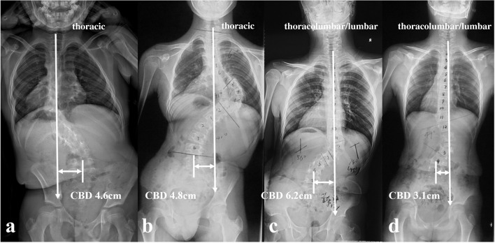 Illustration of the stratification of CCI in DS-NF1: a Thoracic apex with vertical proximal hemi-curve; b Thoracic apex with tilted proximal hemi-curve; c Thoracolumbar/lumbar apex with vertical proximal hemi-curve; d Thoracolumbar/lumbar apex with tilted proximal hemi-curve