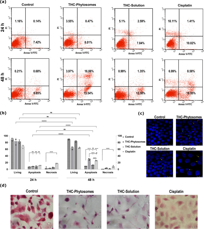 The apoptotic panel of the THC-phytosomes. (a) Representative annexin V/PI flow cytometer dot plots reveal that THC-phytosomes successfully enhance apoptosis in SCC4 cells at 24 and 48 h. (b) An interleaved scatter with bars quantifying the apoptotic cell population percentages in different proposed treatments at both time points. Data expressed as mean ± SD of triplicates (each is one well of 6-well plate seeded with 25 × 104 cancerous cells), where two-way ANOVA followed by multiple comparisons test displays * = p < 0.05, ** = p < 0.01, *** = p < 0.001, and **** p < 0.0001, while ns codes for p > 0.05. (c) Hoechst nuclear-staining photomicrographs (scale bar = 25 μm) show nuclear condensation (red arrow), fragmentation (green arrow), and blebbing of the nuclear membrane (orange arrow). The apoptotic changes appear most evident in the phytosomes group. Cisplatin shows chromatin fading (yellow arrow), indicating necrosis. (d) H&E staining cytological images (scale bar = 20 μm) show the proliferating control cancer cells as well as multinucleated tumor giant cells, depicting the aggressiveness of the cancer behavior. Phytosomes-treated cells are undergoing apoptosis and show extreme shrinkage and apoptotic bodies (inset). With less abundance, the solution-treated group shows similar effects, while cisplatin shows sheets of ghosted cells undergoing cloudy degeneration and nuclear fading