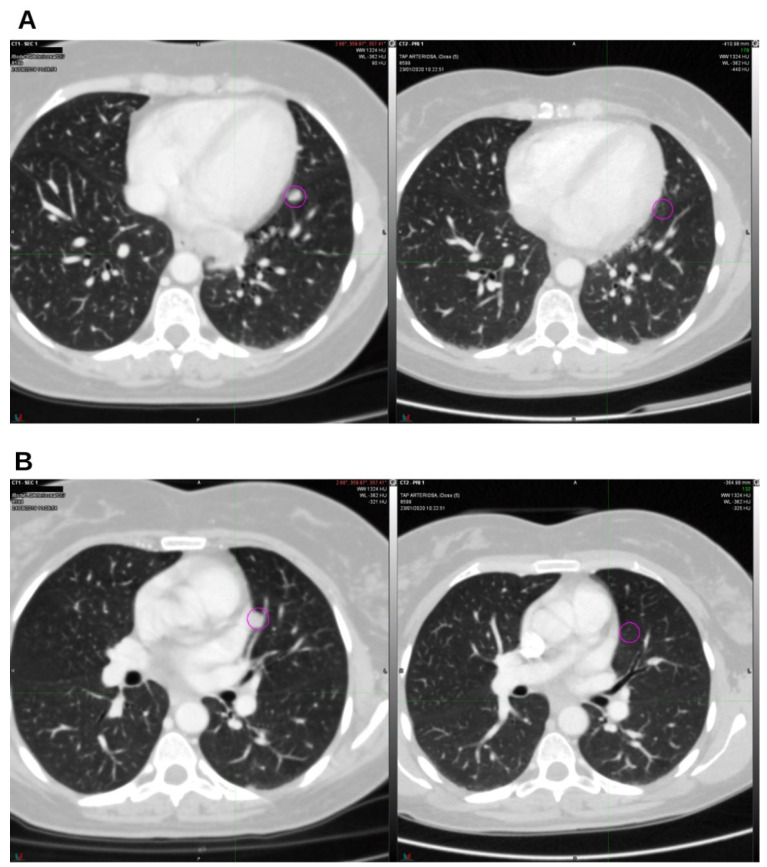 On the left, CT from August 2019; on the right, CT from January 2020. The lingular (A) and parascissural (B) nodules were in complete regression. Nodes in the circles.