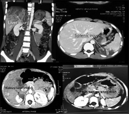 CECT abdomen showing solid organ injuries, CECT: Contrast-enhanced computed tomography