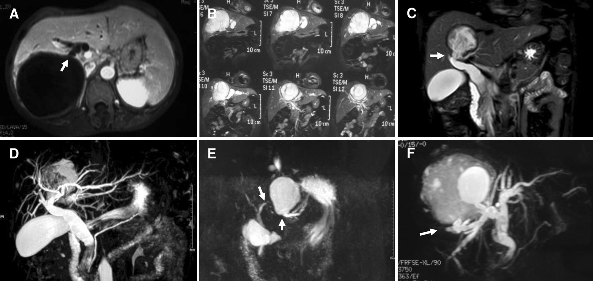 MR/MRCP manifestations of frank cysto-biliary communications. a Cysto-biliary communication (arrow) at right posterior lobe; b cysto-biliary communication of “nested” cyst at main ductal branches of the liver; c cysto-biliary communication (arrow) at right supra section; d cysto-biliary communication (arrow) at right posterior lobe; e left lateral lobular cyst that played as “drainage pool” of the bile via cysto-biliary communication (lower arrow), note that proximal end of left hepatic duct was cramped (upper arrow) due to functional disuse; f cysto-biliary communication (arrow) at right lobe and biliary disuse of superior tributary