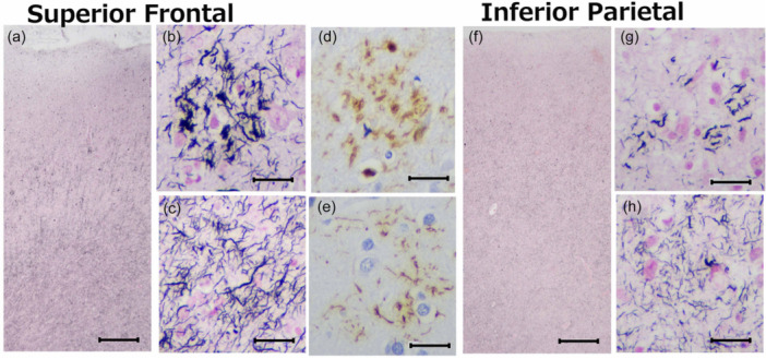 Microscopic findings of the cerebrum. Abundant threads appear in the gray and white matter of the superior frontal lobe (a). The threads are more abundant in the white matter (c) than in the gray matter (b). Astrocytic plaques are seen in the gray matter (b), which are positive for phosphorylated tau (AT‐8) (d), and four‐repeat tau (RD4) (e). The inferior parietal lobes show less abundant neuropil threads (f) than in the frontal lobes. Astrocytic plaques are also seen in the parietal cortex. Threads in the white matter are also more abundant than in the gray matter (h). Gallyas‐Braak silver staining (a–c, f–h), phosphorylated tau (AT‐8) immunostaining (d), and four‐repeat tau (RD4) immunostaining (e). Scale bars: 500 μm (a, f), 25 μm (b–e, g–h).