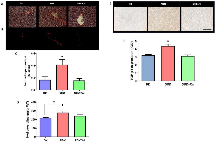 Panel A contains three histology images showing liver tissue stained for collagen in DR, DRS, and DRS plus Ca groups. Panel B presents corresponding fluorescence images. Panel C is a bar graph of liver collagen content, showing significant increase in SRD compared to RD and SRD plus Ca. Panel D is a bar graph of hydroxyproline content, with SRD significantly higher than RD, while SRD plus Ca is not significantly different from RD. Panel E contains immunohistochemistry images for TGF-β1 from RD, SRD, and SRD plus Ca groups. Panel F is a bar graph showing TGF-β1 expression, highest in SRD and reduced in SRD plus Ca relative to SRD.