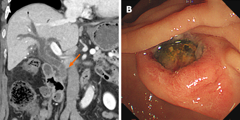 Computed tomography imaging and endoscopic retrograde cholangiopancreatography. A: Follow-up computed tomography demonstrated choledocholithiasis in the extrahepatic bile duct draining the right lobe of the liver; B: An impacted stone was identified at the ampulla of Vater.