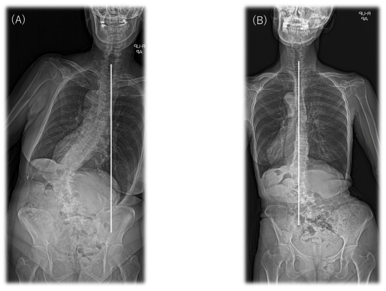 Two types of CM (type 1 and type 2) in patients with ASD classified according to the Obeid CM system. (A) An example of concave (type 1) and (B) convex (type 2) CM. CM, coronal malalignment.