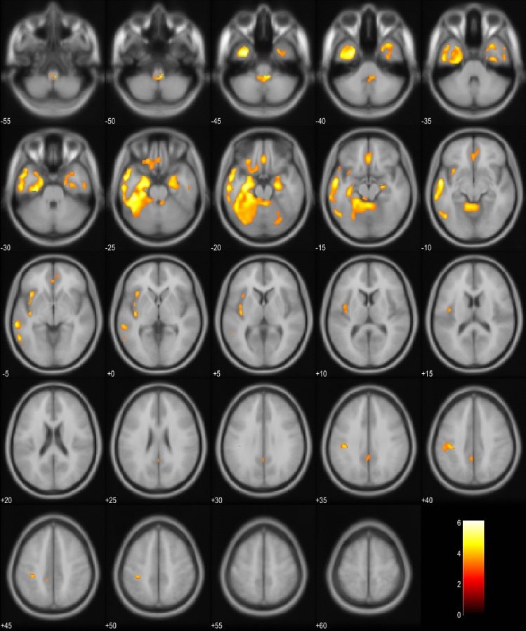 Hypometabolism in bvFTD EP + patients compared to bvFTD EP− patients. Orange and yellow colors represent lower metabolism in the EP + group (p < 0.001, uncorrected). Images are presented in neurological orientation (i.e., left hemisphere presented in left side of the picture)