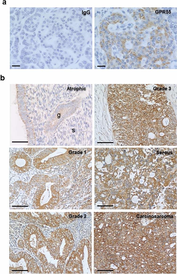 Specificity of GPR55 immunostaining and distribution in normal endometrium and different types of endometrial cancer tissue. Panel a shows immunohistochemical specificity for the anti-human GPR55 antibody using human pancreas as the control tissue. Cell-specific staining was observed within the Islets of Langerhans at an antibody dilution of 1 in 200 (GPR55) whilst an equivalent concentration of non-human rabbit IgG showed no staining (IgG). A higher concentration of antibody (1 in 100 dilution) lightly stained acinar cells indicating non-specific staining. Panel b shows representative staining of human endometrium from control (atrophic), and Type 1 EC (grades 1, 2 and 3) and Type 2 EC (serous and carcinosarcoma) biopsies. Weak staining in the epithelial glands (g) of control tissue was observed with little or no staining in the stroma (s). By contrast, more intense glandular epithelial cell staining was observed in the different malignant tissues, with some light staining of the stroma in the grade 1, Type 1 EC samples. Bar = 50 µm