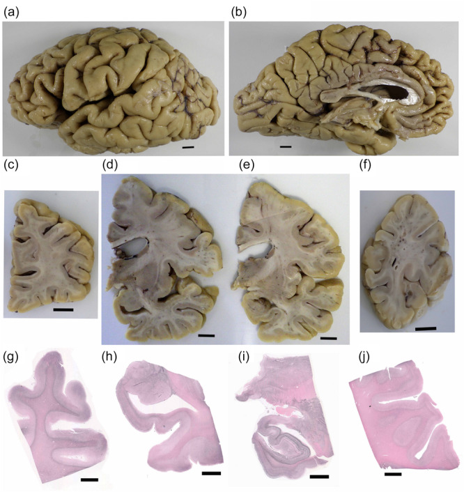 Macroscopic and semi‐macroscopic findings. Focal atrophy is evident in the frontal cortices (a) and medial frontal cortices of the cerebrum (b). Moderate atrophy of the frontal cortices (c) and mild atrophy of the temporal cortices can be visualized in the coronal sections of the cerebrum (d, e). The motor (e), parietal, and occipital cortices (f) are intact. Gallyas‐Braak silver staining reveals severe tau pathology in the superior frontal cortices (g), amygdala and entorhinal cortices (h), inferior temporal cortices, hippocampus, and pallidum (i). Tau pathology is relatively mild in the parietal cortices (j). Gallyas‐Braak silver staining (g–j). Scale bars: 10 mm (a–f), 5 mm (g–j).
