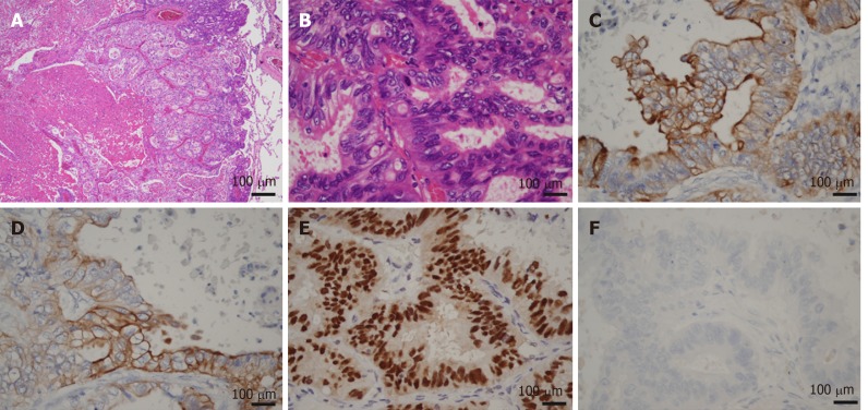 Microscopic images of lung metastasis. A and B: Histologic appearance showed a well-demarcated nodule with marked necrosis in the center of the tumor (A: magnification × 20, B: magnification × 400). At high power magnification, there were eosinophilic, tall, columnar cells with nuclear pseudostratification. C-E: Immunohistological staining showed that the tumor cells were positive for CK7 (Panel C), CK20 (Panel D) and CDX2 (Panel E); F: Immunohistological staining showed that the tumor cells were negative for TTF-1.