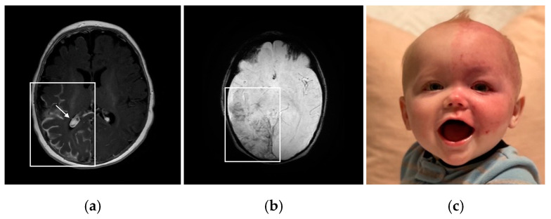 (a) Patient 1: T1-weighted post-contrast axial MRI showing unilateral right leptomeningeal enhancement (box) and enlarged choroid plexus (arrow). (b) Patient 1: Susceptibility-weighted axial MRI showing right occipital and temporal lobe cortical calcification and dilated deep draining vessels (box). (c) Patient 2: Infant with SWS presenting a unilateral left-sided facial PWB and glaucoma.