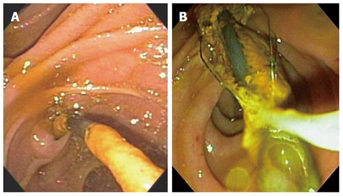 Brown stone stuck tightly to stent was removed by stone retrieval basket (A and B).