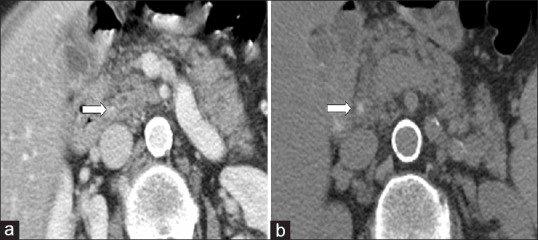 A 74-year-old woman presenting with acute pancreatitis. The images are of transverse MDCT with no positive intraduodenal contrast filling. (a) On this IV contrast-enhanced image, a stone was missed by both observers due to the relative isoattenuation with surrounding enhancing structures (straight arrow). (b) The stone was easily detected on the original clinical CT reading, since it was clearly seen on the unenhanced acquisition (straight arrow)