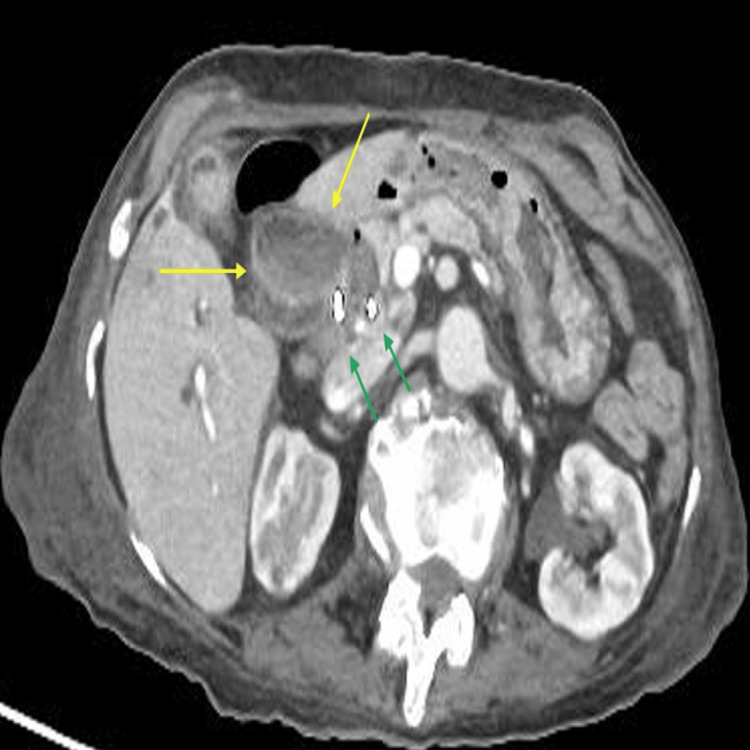 Abdominal CT axial image with high attenuated blood products along the intrahepatic and dilated biliary ducts (yellow arrows). Also seen are pigtail stents inserted previously during ERCP to help drainage (green arrows).CT: computed tomography; ERCP: endoscopic retrograde cholangiopancreatography