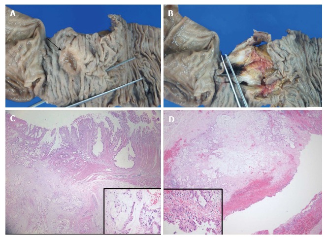 Gross specimen and pathological findings. A: The ulcerofungating mass measuring 2.4 cm × 2.0 cm (arrow), 2.5 cm distant from the ampulla of vater, is observed in the duodenum; B: The cut surface reveals a grey-white mass that abuts the head of the pancreas; C: Histologically, the duodenal mass proved to be an infiltrative adenocarcinoma with subserosal invasion, note the abundant extracellular mucin with floating neoplastic epithelium (Inset); D: Photomicrograph of the cystic mass shows invasive tumor cells in the lining of the cyst and the surrounding soft tissue which is a definite malignant feature (Inset).