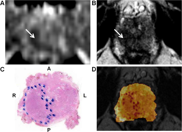 Coregistration of anatomical imaging and histology. Prostatic MRI examination in patient 4. ADC map shows restricted diffusion in low-signal tumour mass in the right peripheral zone (arrow) (A). The corresponding transversal T2w MRI image shows a low-signal-intensity mass (arrow) (B). Photomicrograph from a tissue cross section obtained after RP. The tumoural lesion on the right is outlined (blue dots) (C). Fusion of the transverse T2w MRI image with the corresponding tissue cross section (D).