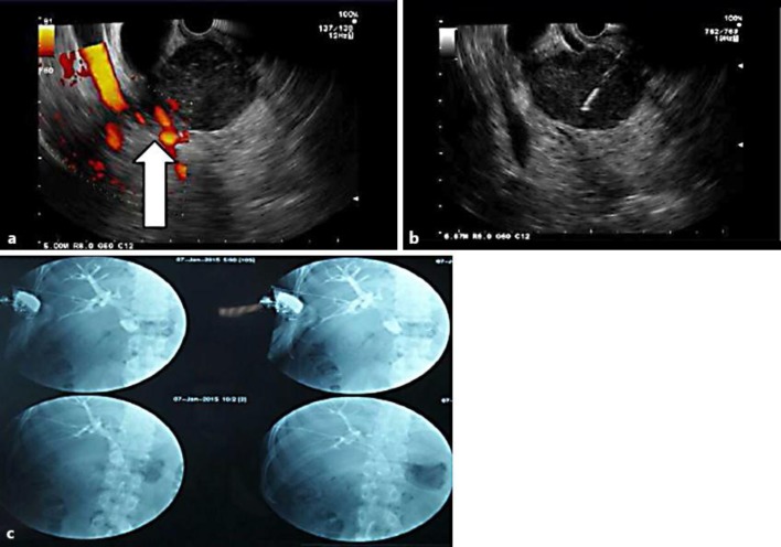 a EUS image showing the pancreatic head mass that infiltrated the portal vein (Doppler image). b EUS image showing the FNA procedure. c PTBD images using fluoroscopy.