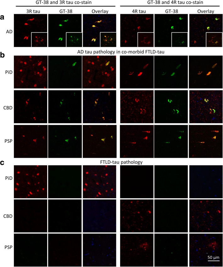 GT-38 detects pathological tau aggregates containing 3R and 4R tau isoforms. Co-immunofluorescent staining of GT-38 with 3R- or 4R-tau specific antibodies in a AD midfrontal cortex, b CBD, PSP, and PiD hippocampus in regions with co-occurring AD-tau pathology, demonstrating complete colocalization with 4R tau in the context of PiD and complete colocalization with 3R tau pathology in the context of CBD and PSP, c GT-38 negative regions in CBD, PSP, and PiD hippocampus without concomitant AD-tau pathology, but with tau pathology comprised of only 3R- or 4R-tau respectively