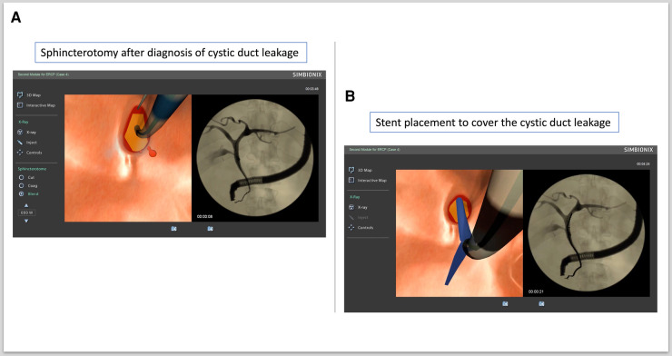 Diagnosing and treating cystic duct leakage. (A) Sphincterotomy after diagnosis of cystic duct leakage. (B) Stent placement to cover cystic duct leakage.