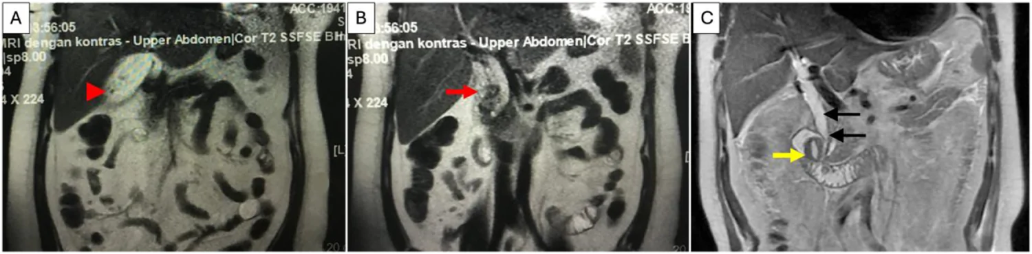 T2-weighted MRCP coronal view showing (A) multiple cholecystolithiasis (red arrowhead), (B) sludge within the CBD (red arrow), and (C) periampullary diverticulum (yellow arrow) adjacent to the ampulla, compressing the distal CBD (black arrowheads).