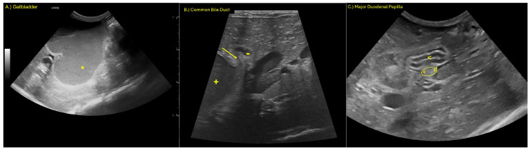 (A) Marked dilation of the gallbladder (*), (B) marked dilation of the CBD (+) with luminal tapering (arrow) and mild distension of the pancreatic duct (-), and (C) major duodenal papilla (oval) entering the duodenum (<).