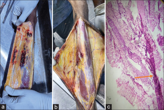 (a and b) Thickening of cubital veins and blood extravasation were noted underlying the track marks in Case no. 1, 2. (c) Foreign-body granuloma in vessel underlying track mark in Case no. 5. Arrow showing prominent cubital veins