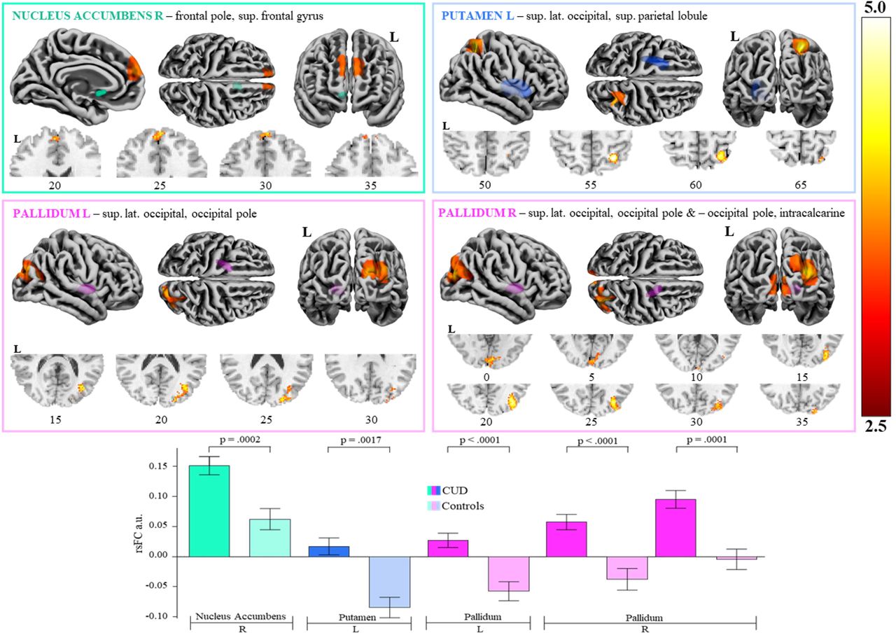 Significantly greater resting-state functional connectivity in people with a Cannabis Use Disorder compared to controls, between ROI seeds & clustersa.u., arbitrary units; CUD, cannabis use disorder; L, left; lat., lateral; rsFC, resting-state functional connectivity; ROI, region of interest; sup., superior