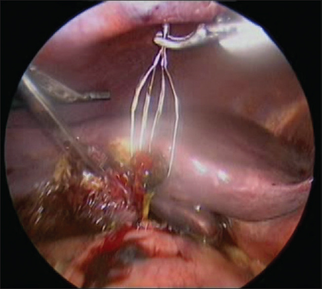 Impacted Dormia basket with stone in common bile duct