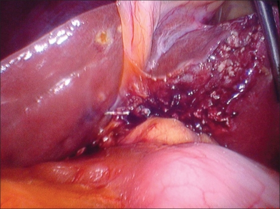 Left sided gall bladder (Removed)