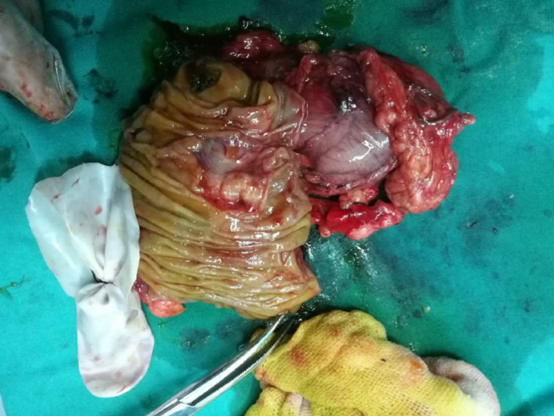 The gross specimen appearance of an irregular mass of the distal common bile duct near the papilla.
