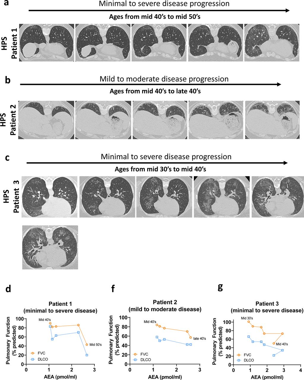 Time dependent changes in circulating AEA levels in HRCT guided progression of HPSPF.Representative HRCT images in HPS patient 1 (A), HPS patient 2 (B), HPS patient 3 (C) who had progressive HPSPF. Age dependent changes in AEA levels in serum in HPS patient 1 (D), HPS patient 2 (E), HPS patient 3 (F).
