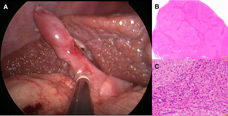 Histopathological findings at hepaticojejunostomy. Chronic hepatitis and fibrosis, F3, A2. (A) Intraoperative findings (B) An enlarged portal area and bridging fibrosis were observed (Hematoxylin Eosin staining ×10). (C) Proliferation of regenerated bile ducts and the infiltration of neutrophils and lymphocytes were observed (Hematoxylin Eosin staining ×200).