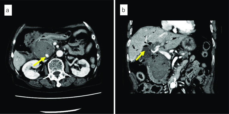 Preoperative enhanced CT findings. a Transverse image. Contents of the cystic lesion of the pancreatic head reveal a relatively high CT number. An arrow shows pseudoaneurysm in the cystic lesion. b Coronal image. The gallbladder had been resected. An arrow shows the suspicious structure of the elevated jejunum adjacent to the gallbladder bed