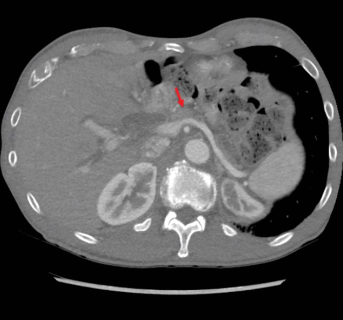 CT image revealing a pancreatic neck mass (arrow) measuring 2.2 × 1.3 cm, with dilated intrahepatic bile ducts and patent splenic vein and portal vein. CT, computed tomography.