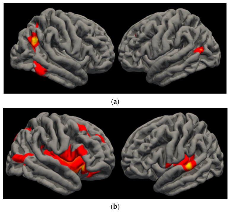 VO2 Findings. (a) Lateral view of VO2 finding observed in right inferior parietal, right inferior temporal, left superior parietal (not pictured), and left inferior parietal SA. Greater VO2 was associated with more area in these regions. (b) Lateral view of VO2 finding observed in right lateral orbitofrontal, right inferior parietal, and left superior temporal LGI. Greater VO2 was associated with more gyrification in these regions.