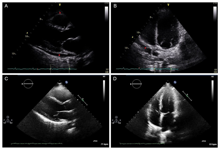 The patient’s 2-dimensional transthoracic echocardiography on admission and outpatient follow-up: (A) Parasternal long-axis view—The red stars indicate the circumferential pericardial effusion on admission. (B) Apical 4-chamber view—The red star indicates the pericardial effusion on admission. (C) Parasternal long-axis view—There is complete interval resolution of the pericardial effusion on the 4-week outpatient follow-up visit. (D) Apical 4-chamber view—There is complete interval resolution of the pericardial effusion on the 4-week outpatient follow-up visit.