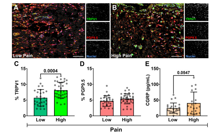 TRPV1 and PGP9.5 neural distribution relative to KOOS pain(A) Representative 200× confocal photomicrographs of co-labeled TRPV1 (green), PGP9.5 (red), and nuclei (blue) in representative patient synovium from the (A) low-pain (KOOS Q3 ≥ 47.20) and (B) high-pain (KOOS Q1 ≤ 22.20) cohorts. Corresponding grayscale channels are shown to the right of A and B (bar = 100 µm). Bar graphs with individual data points comparing mean ± SD expression percentage from Q-IF detection of (C) TRPV1 distribution and (D) PGP9.5 nerve fibers and synoviocytes (normalized to cell count) between KOOS pain groups (Student's t-test, α = 0.05). (E) Bar graph with individual data points comparing CGRP concentration (pg/mL) in SF measured by ELISA, between KOOS pain groups (Student's t-test, α =0.05).TRPV1: transient receptor potential vanilloid 1, PGP9.5: protein gene product 9.5, KOOS: Knee Injury and Osteoarthritis Outcome Score, SD: standard deviation, Q-IF: quantitative immunofluorescence, CGRP: calcitonin gene-related peptide, SF: synovial fluid, ELISA: enzyme-linked immunosorbent assay