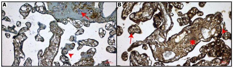CNR2 immunostaining of placental sections. (A): Control group: Weak expression of CNR2 in decidual cells (arrow) and chorionic villi (arrowhead), (B): COVID-19 group: Intense expression of CNR2 in chorionic villi (arrow), syncytial knots (arrowhead) and connective tissue (asterisk). Bar: 50 μm (magnification: 20×).