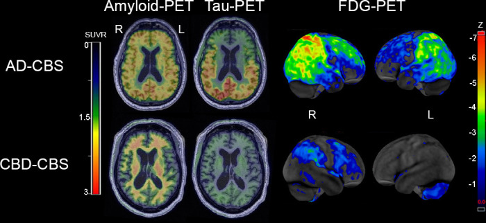 Representative amyloid PET with [11C]PiB, tau PET with [18F]flortaucipir and glucose PET with [18F]fluoro-2-deoxyglucose (FDG) in AD-CBS and CBD-CBS. The amyloid PET and tau PET are shown on representative axial slices on the same colour scale, while the FDG-PET highlights regional metabolism with z-scores between −1 and −7 SD from controls using CortexID suite software. Upper images are from a patient with AD-CBS. Amyloid PET shows diffuse ligand uptake in cortical grey matter, and tau PET reveals increased signal in the temporo-parieto-occipital lobes. FDG-PET reveals hypometabolism in bilateral parietal cortex extending into occipital lobes (right >left) and right >left superior frontal cortex. Lower images are from a patient with CBD-CBS. There is no evidence of increase amyloid PET uptake in the cortical grey matter and there is no increase tau PET uptake. FDG-PET reveals mild hypometabolism in the right premotor cortex and postcentral gyrus in CBD-CBS. AD-CBS, Alzheimer’s disease presenting as corticobasal syndrome; CBD-CBS, corticobasal degeneration presenting as corticobasal syndrome; FDG, fluorodeoxyglucose; L, left; PET, positron emission tomography; PIB, Pittsburgh compound-B; R, right; SUVR, standardised uptake value ratio.