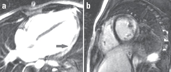 (a, b) Cardiac MRIs showing late gadolinium enhancement (LGE) in posterolateral portion of the heart (arrows), which is consistent with an old myocardial infarction