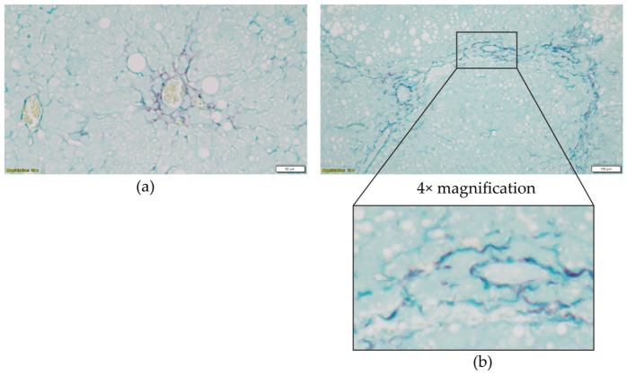 Liver fibrosis. Representative images stained with picrosirius red for collagen and counter stain fast green for other structures (i.e., nucleus and cytoplasm). Red stains indicate fibrosis. (a) F1, pericellular fibrosis around a central vein; (b) F3, bridging fibrosis; magnified insert showing fibroblasts laying down collagen fibres.